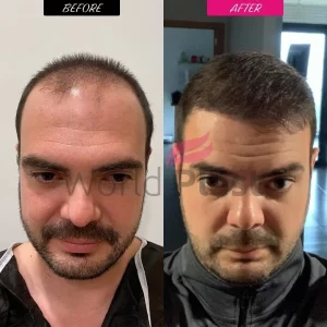 hair transplant turkey before after
